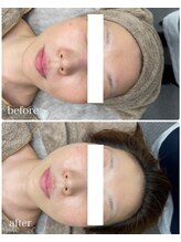 べっぷ餅ヶ浜鍼灸院/ララピールBefore/ After