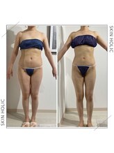 スキンホリック 恵比寿駅前店(SKIN HOLIC)/全身☆痩身ビフォア＆アフター★