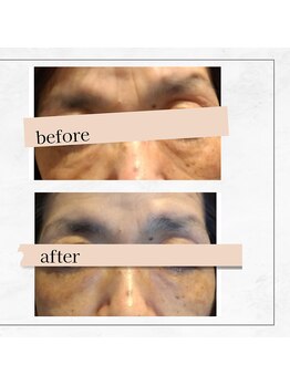 リル(RIRE)/プラズマエステ