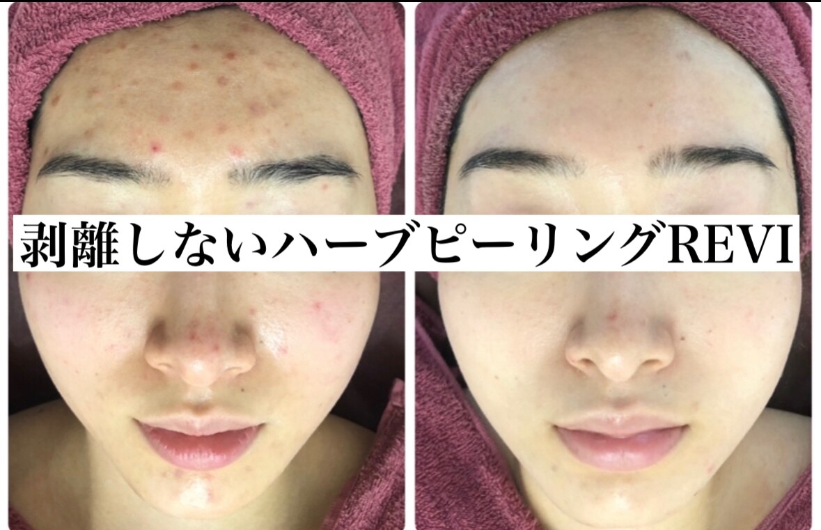 美ラボ様限定剥離ありハーブピーリング50回分 リセットラボ 本店(Reset Lab)｜ホットペッパービューティー 美