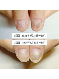 自爪育成/深爪矯正後の成長記録