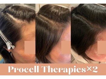 イーフェイス(e face)/プロセルセラピーズ頭皮