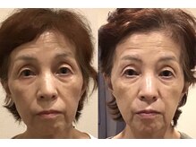 ユー 喜連西店(U)/美容鍼