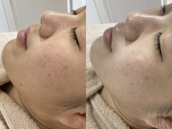 キヌ(KINU)/症例写真（くすみ）