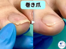 プラスワンフット 本厚木(+1 Foot)/巻き爪矯正は専門店へ●