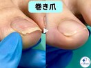 巻き爪矯正は専門店へ●