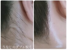 サロン ド モア(salon de MORE)/うなじのダブル脱毛