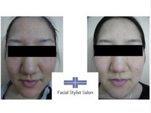 フェイシャルスタイリストサロン 四谷店/ケア例(９)