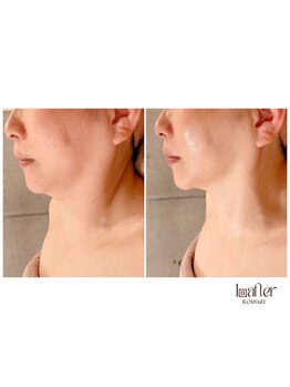 サプナジー(Suppnrgy)/小顔コルギ