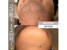 アカラビューティー(Akala Beauty)の雰囲気（当店大人気はひげ脱毛です！！）