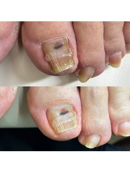 巻き爪矯正3回目（左親指）