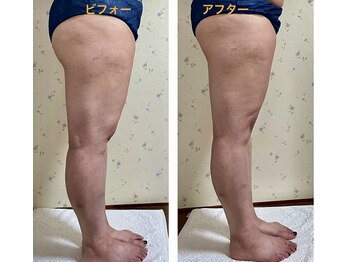 ラレコルト/ビフォーアフター