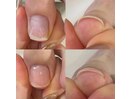 特集ジェルで巻き爪ケア