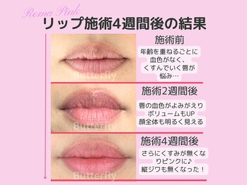 バタフライ 平塚店(Butterfly)/血色が悪くなった唇がピンク色に