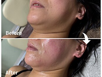 サロンドモモ(SALON de MOMO)/小顔★顎下ビフォーアフター