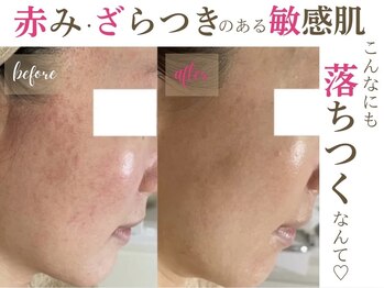 ソワンドビジュー(soin de bijew)/ハーブピーリングでなめらか肌