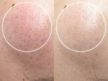 キヌ(KINU)/症例写真（赤み）