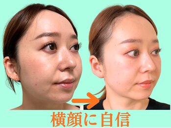 ナチュラルパーフェクトフェイス 新宿/横顔が整う/新宿小顔/渋谷区小顔