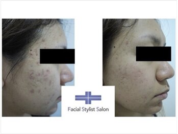 フェイシャルスタイリストサロン 四谷店/ケア例(10)