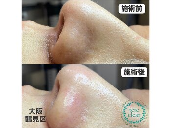 リッカロッカ(RIKKA&ROCCA)/毛穴エクストラクション