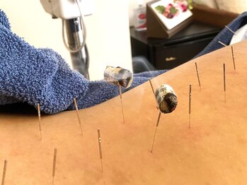 みなとみらいの空/灸頭鍼は身体の芯まで温まります