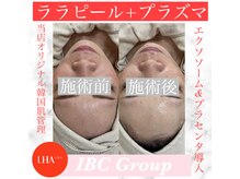 トータルサロンアイビーシー(トータルサロンIBC)/ララピール×プラズマゼノ