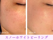 オーシャンブルー 大分店(OCEAN BLUE)/スノーホワイトピーリング