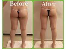 トータルビューティサロン クイーン(Queen)/エンダモロジー【モニター】