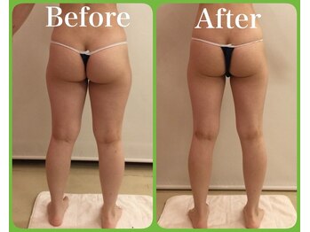 トータルビューティサロン クイーン(Queen)/エンダモロジー【モニター】