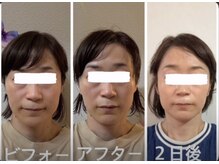 アクアナチュラ(ACQUANATURA)/お顔のむくみスッキリ！！