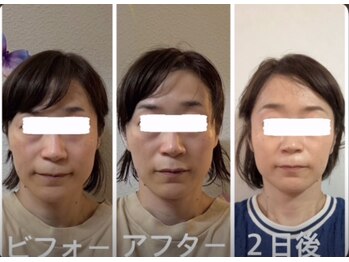 アクアナチュラ(ACQUANATURA)/お顔のむくみスッキリ!!