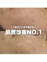 ジェノール 2nd beauty studio 姫路駅前店(JNOEL)/1回で変わる！ハーブピーリング