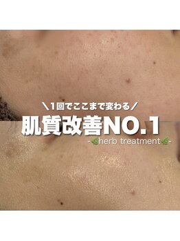 ジェノール 2nd beauty studio 姫路駅前店(JNOEL)/1回で変わる！ハーブピーリング