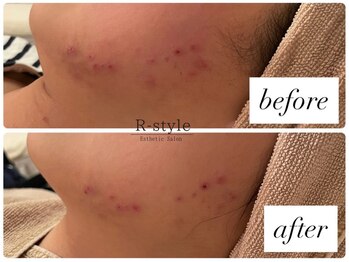 エステサロン アールスタイル(R-style)/プラズマビフォーアフター写真