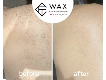 シエルエトワール 唐津店(Ciel Etoile)/匠道 背中脱毛