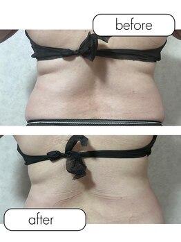 カピリナ(Kapilina)/ WINBACK60 1回【40代後半女性】