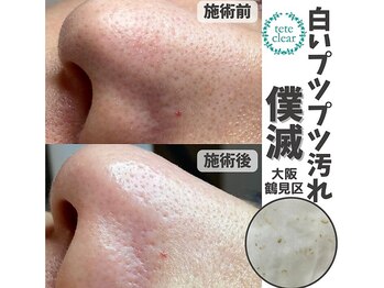 リッカロッカ(RIKKA&ROCCA)/白いプツプツ汚れ僕滅