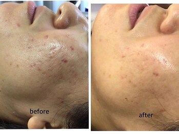 ミロク(369)/before&after プラズマ