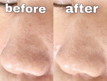 ルピエ(Lupir)/毛穴洗浄＆ハーブピーリング