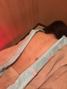 フィットジユウガオカ(Fit_Jiyugaoka)/背中鍼は全身調整 鍼/インディバ