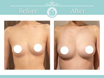 美人バスト 吉祥寺店/バストアップ /【症例写真】　☆