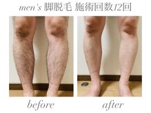 エミナル(EMINAL)/men's 脚脱毛