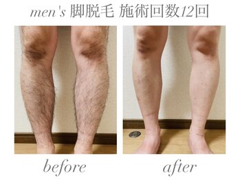 エミナル(EMINAL)/men's 脚脱毛