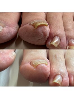 巻き爪矯正3回目(左親指)