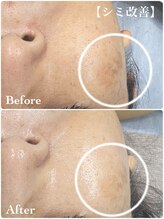 ミレーヴ(MiReve)/シミ・シワ