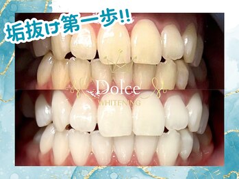 ドルチェ(Dolce)/ビフォーアフター