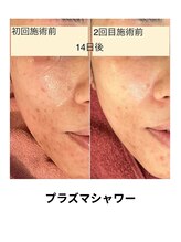 ビービー(BB)/プラズマシャワー＋導入