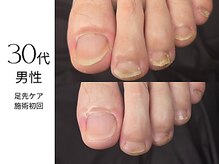 フットケア クラッシー(footcare classy)/男性　爪切り　指先ケア　右足