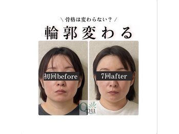 キュープ 北千住店(Qpu)の写真/憧れの小顔へ◎歪みの原因にアプローチ!人生で一番小さな顔にあなたも出会える☆