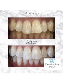 ホワイトニングショップ 秋田店/【before after】 美白